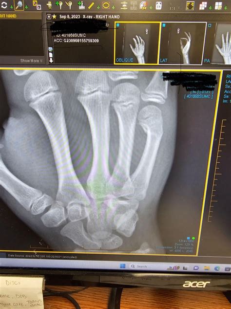 Will this require surgery? : r/Orthopedic