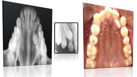 Maxillary canine