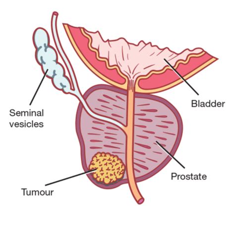 Prostate Cancer Prostate Disorders Flashcards Quizlet