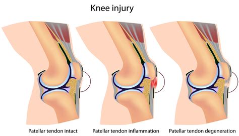 Patella Tendinitis | Physiotherapy Treatment Singapore. Fast pain