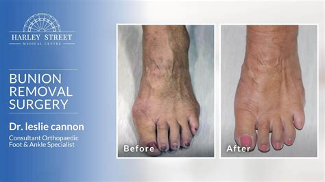 foot bunion removal surgery