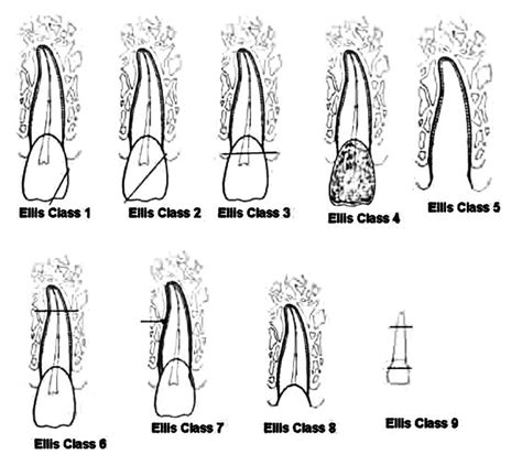 Ellis And Davey Classification Of Tooth Fracture 1960