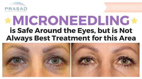 Microneedling Is Safe Around The Eye Area But May Not Be Most Suitable