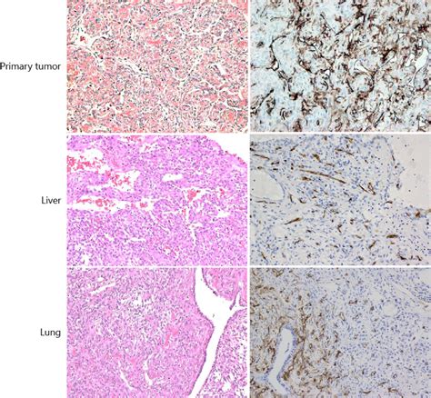 Microscopic Features Of The Solitary Fibrous Tumor The Primary Renal