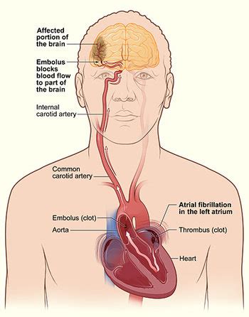 What is an Embolic Stroke? | Study.com