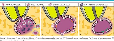 Figure 1 From The Paradigm Of The Inflammatory Radicular Cyst Biological Aspects To Be