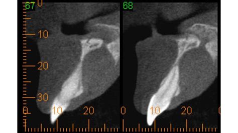 Melanoma Patologia Bucal