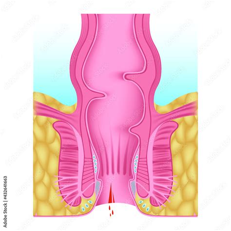 Anal Fissure Hemorrhoids Of The Anal Opening Digestive System Anatomy Medical Chart