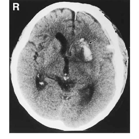 Postoperative Computed Tomography Scan 3 Days Later Demonstrating