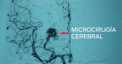 Microcirug A Cerebral Dr Pablo Pe A