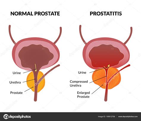 Cartel De Patología De La Prostatitis Stock Vector By ©arseniukoleksii