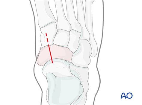 Temporary Bridging Of Talonavicular Joint For Complete Articular
