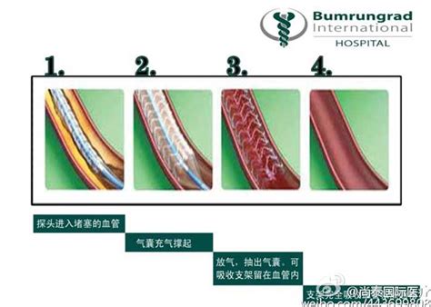 可溶解心脏支架301医院 心支架价位 心支架什么样子 大山谷图库