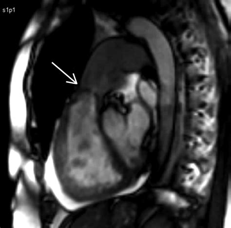 Multimodality imaging in heart valve disease | Open Heart