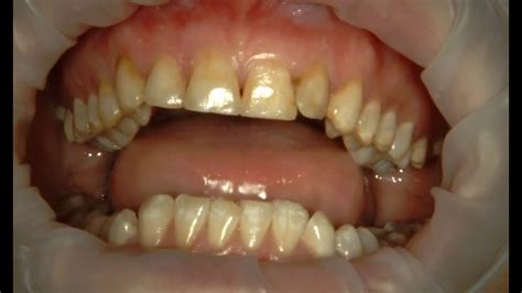 Композитная реставрация зубов при флюорозе (желтые зубы) + исправление ...