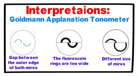 Interpretations Goldmann Applanation Tonometer Youtube