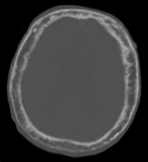 Paget Disease Of Bone Concise Medical Knowledge
