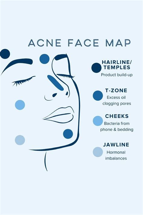 Acne Face Map In 2023 Face Mapping Acne Face Acne Face Mapping