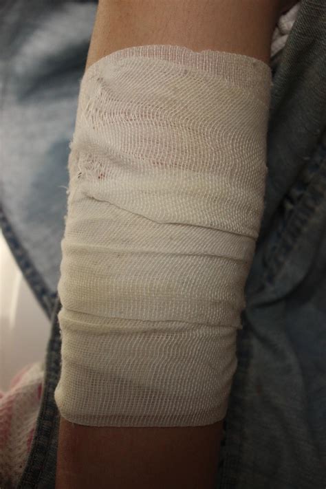 Healing My Daughter's Second-Degree Burn - Jill's Home Remedies