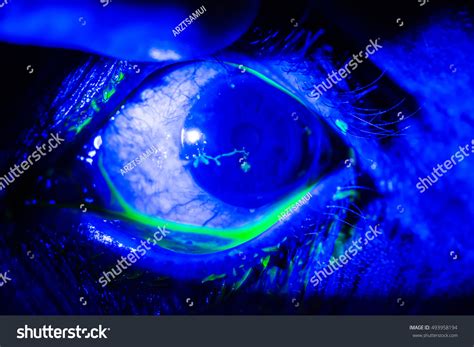 close herpes simplex keratitis  eye stock photo