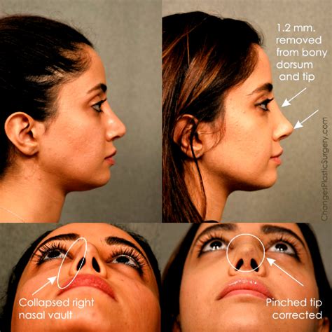 Revision Rhinoplasty Corrections To Dorsum And Collapsed Right Nostril