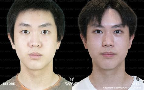 Top Epicanthoplasty Surgeons in Los Angeles | Eyelid Surgery