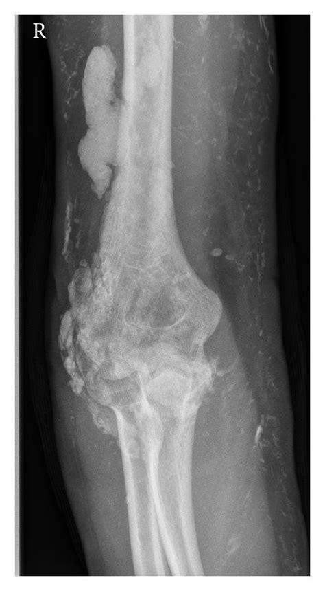 Standard Elbow Radiographs Of A Year Old Woman With Calcinosis