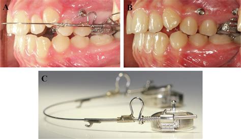 Clinical Effectiveness Of Buccally And Palatally Anchored Maxillary