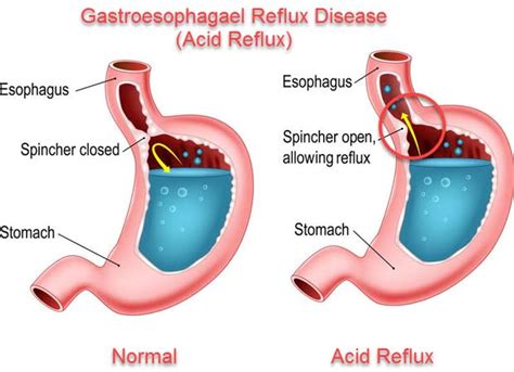 Acid Reflux - Mahaba Herbal Limited