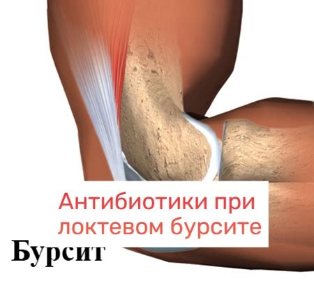 Антибиотики при бурсите локтевого сустава какие можно принимать