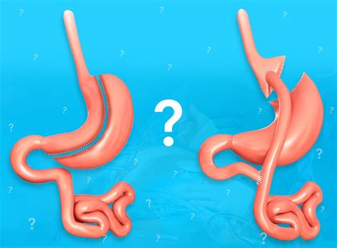 Gastrik bypass nasıl olur neden yapılır Doç Dr Muzaffer Al