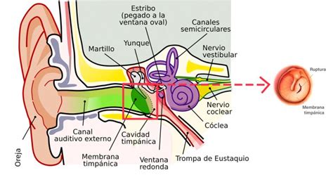 Cómo saber si me he perforado el tímpano Asistencia Médica Inmediata