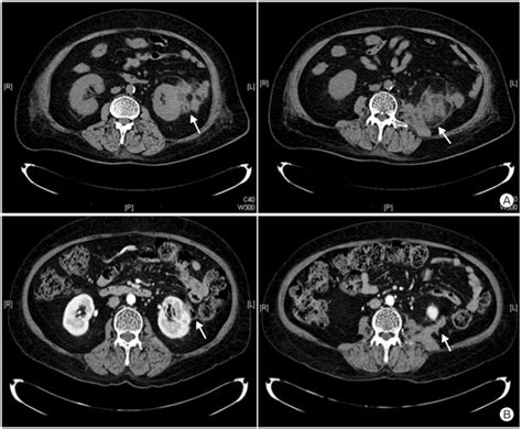 Abdomen Pelvic Computed Tomography Ct Scan An Abdomen Pelvic Ct