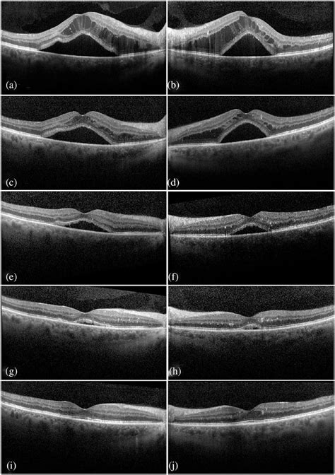 Optical Coherence Tomography At Presentation Demonstrated Severe Download Scientific Diagram