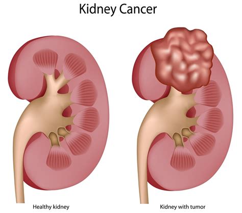 kidney cancer  symptoms signs stages treatment