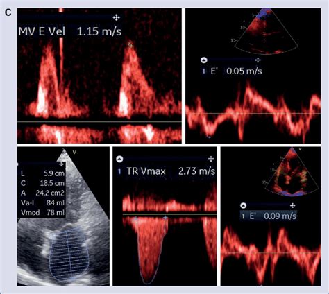 Cont C A 75 Year Old Woman With Atrial Fibrillation Resting Download Scientific Diagram