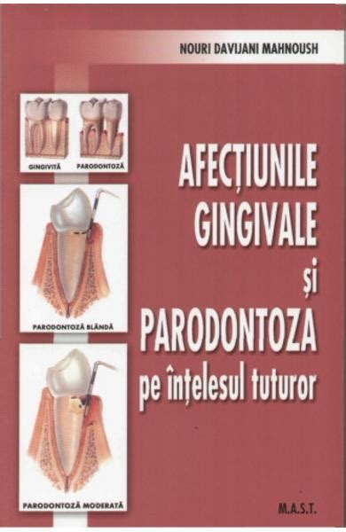 Afectiunile Gingivale Si Paradontoza Pe Intelesul Tuturor Nouri