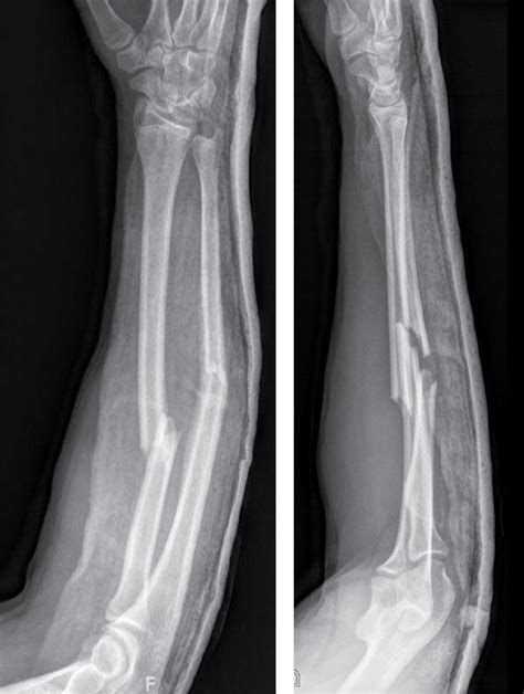 Fracturas De Miembro Superior Fracturas Miembro Superior Udocz My Xxx Hot Girl