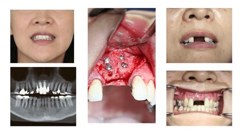 Bone Grafting Before & After | Oral Surgeon in Honolulu HI