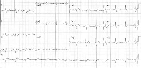 Electrocardiograma De Derivaciones Elevaci N De St De Mm En