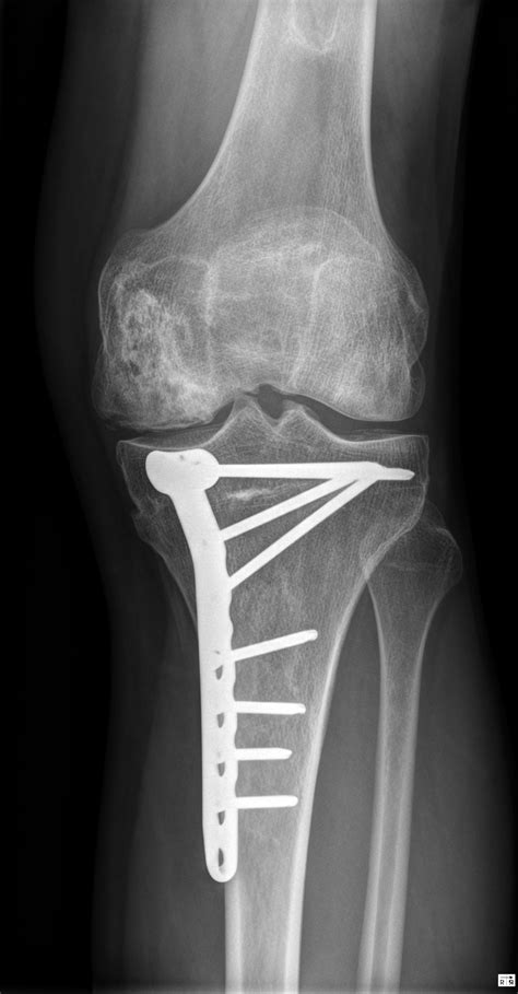 Avascular Necrosis Steroid Induced Image Radiopaedia Org