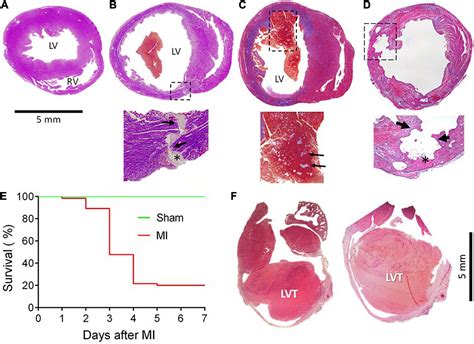 Frontiers Pathogenetic Link Of Cardiac Rupture And Left Ventricular