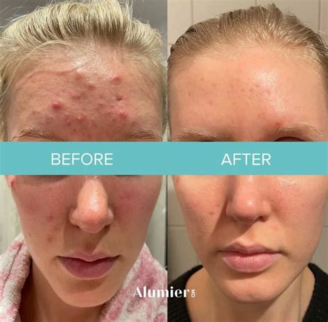Alumier Chemical Peel In Wigan And St Helens Natural Nurse Aesthetics