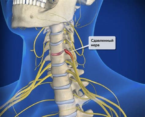 Воспаление шейного нерва симптомы и лечение фото