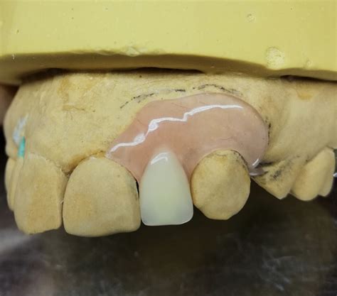 Prótesis Semiflexibles Jordano Laboratorio Dental