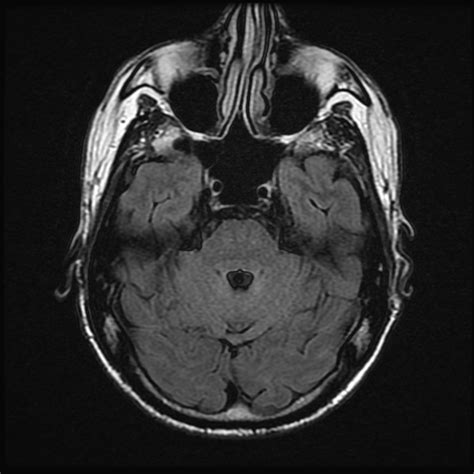 Mri Faceorbitneck Js Radiology