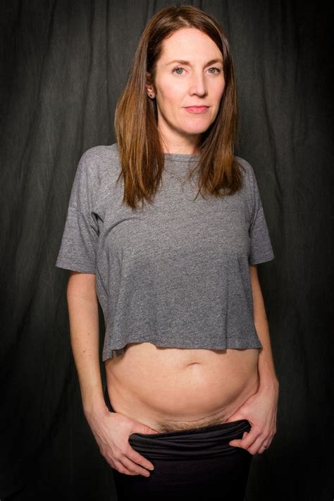 10 Moms Showed Us Their C Section Scars And Shared The Intimate Details