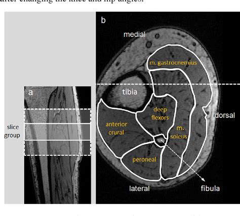 Soleus Muscle Mri