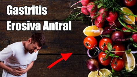 Dieta Para La Gastritis Erosiva Antral Youtube