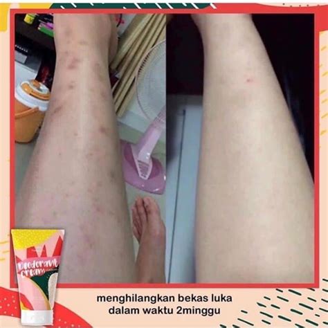 Cara Hilangkan Parut Kudis Hitam